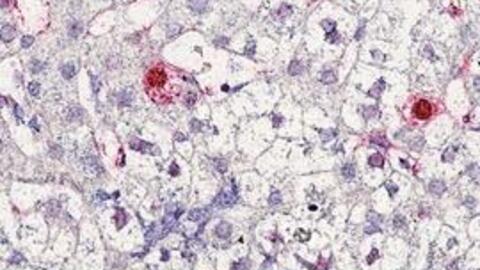 Phát hiện virus mới gây bệnh viêm gan ở người