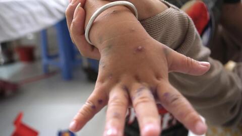 Tay chân miệng ở ĐBSCL báo động, trẻ có khả năng mắc bệnh 2-3 lần