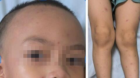 Bé trai 4 tuổi mắc đồng thời zona thần kinh và thủy đậu