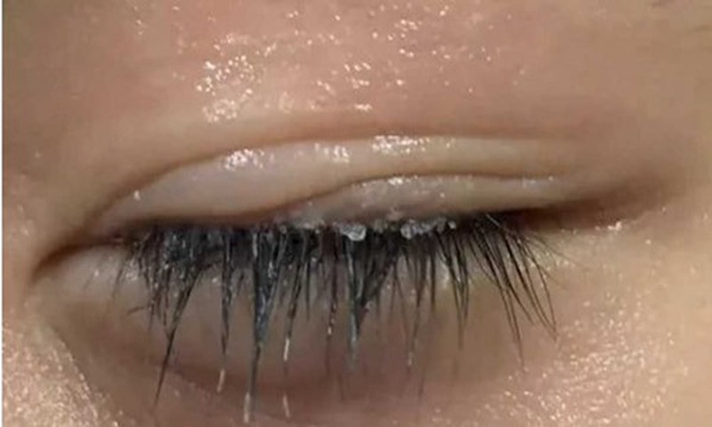 Bé trai 3 tuổi bị keo 502 bắn vào mắt, hành động của người mẹ trong “30 giây vàng” đã cứu con khỏi cảnh mù loà!- Ảnh 2. Bé trai 3 tuổi bị keo 502 bắn vào mắt, hành động của người mẹ trong “30 giây vàng” đã cứu con khỏi cảnh mù loà!- Ảnh 2.