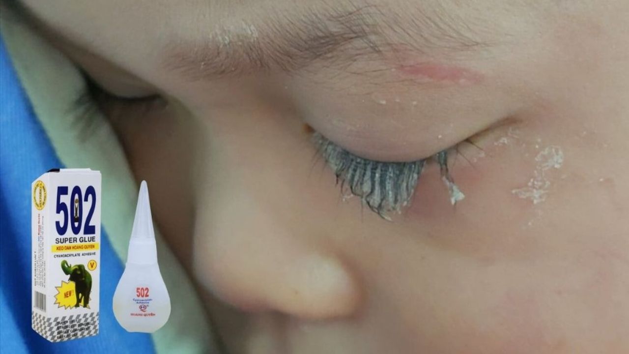 Bé trai 3 tuổi bị keo 502 bắn vào mắt, hành động của người mẹ trong “30 giây vàng” đã cứu con khỏi cảnh mù loà!- Ảnh 1. Bé trai 3 tuổi bị keo 502 bắn vào mắt, hành động của người mẹ trong “30 giây vàng” đã cứu con khỏi cảnh mù loà!- Ảnh 1.