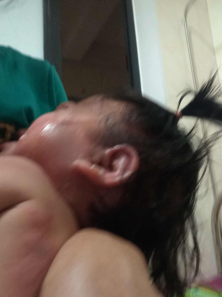 Phần mặt và đầu của bé Như Quỳnh bị bỏng nặng khi ngã vào nồi canh đang sôi. anh2.jpg