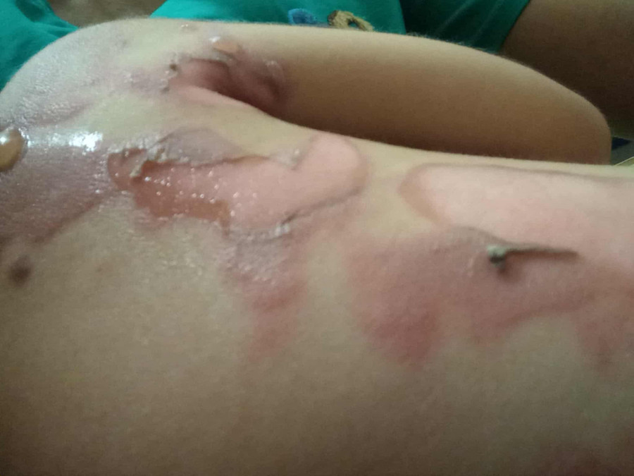 Khắp người của bé Như Quỳnh cũng bị phồng rộp, bong tróc. anh1.jpg