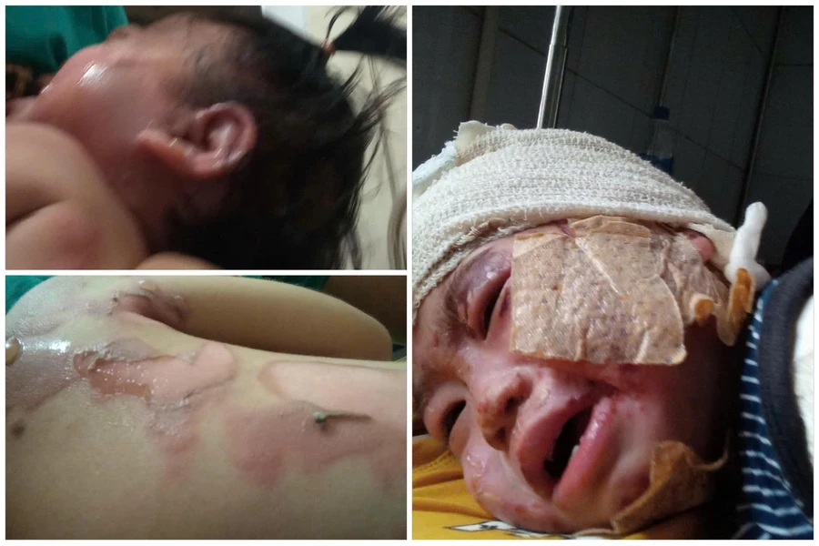 Bị ngã vào nồi canh đang sôi khiến bé Như Quỳnh bỏng nặng.