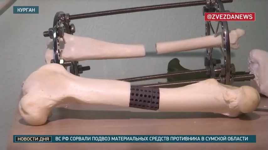 Công nghệ titan mới mở ra cách thay xương chưa từng có